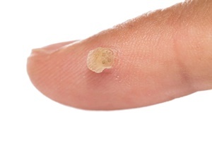A wart is a skin condition which effective skin cell Pro fights