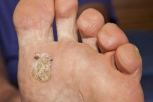 the causes of the plantar wart