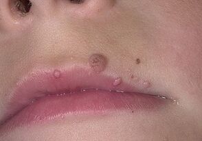 why papillomas appear on the lips