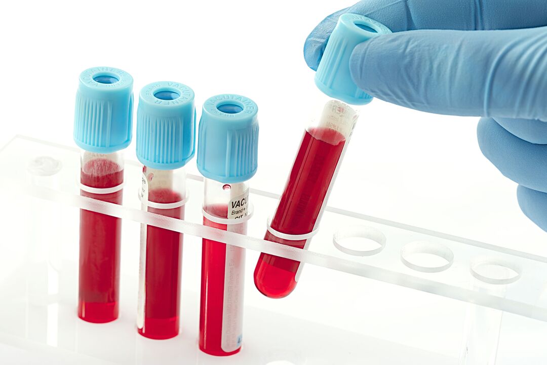 Blood test to diagnose human papillomavirus