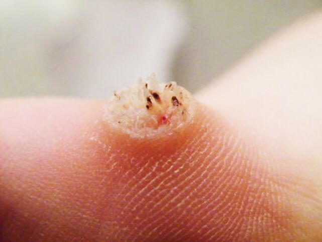 A wart on the skin that needs to be removed with pharmacy products