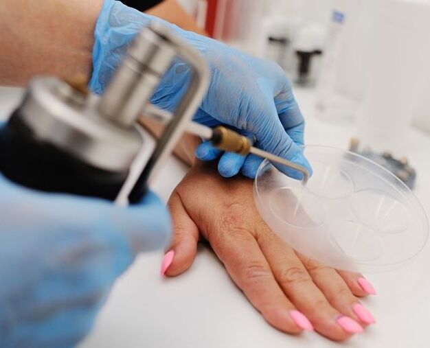 Cryodestruction - a method of removing warts on the hands by freezing them with liquid nitrogen