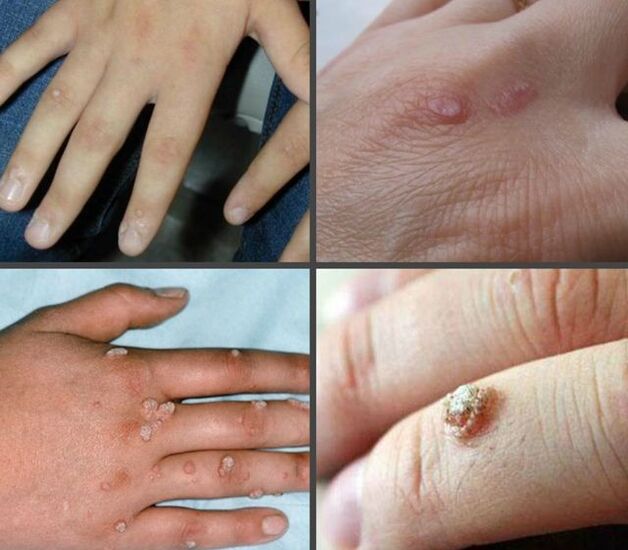 The appearance and localization of warts on the hands