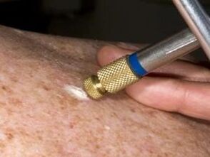 Removal of papillomas on the body with liquid nitrogen