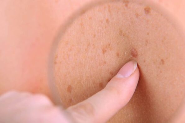 Papillomas on human skin